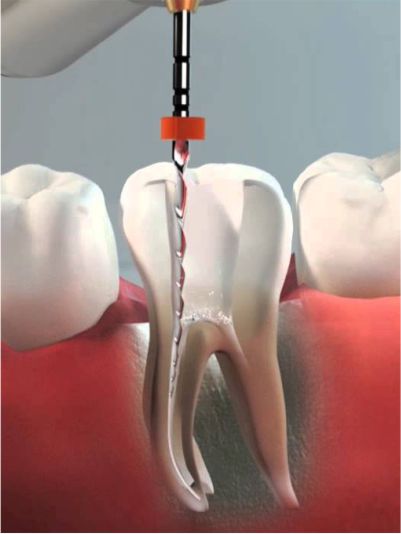 endodoncia